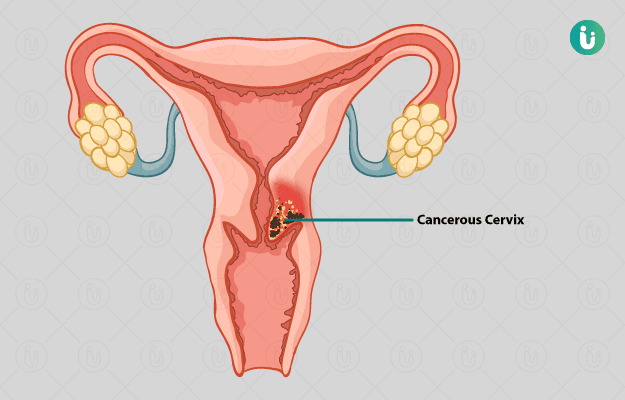 Cervical Cancer: Leading Cause of Death in Women, 1,493 Die Yearly in Nepal.