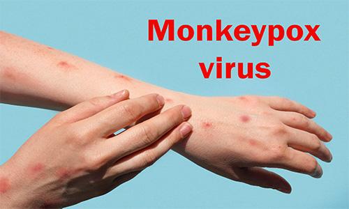 A Nepali Man Diagnosed With Monkeypox Virus